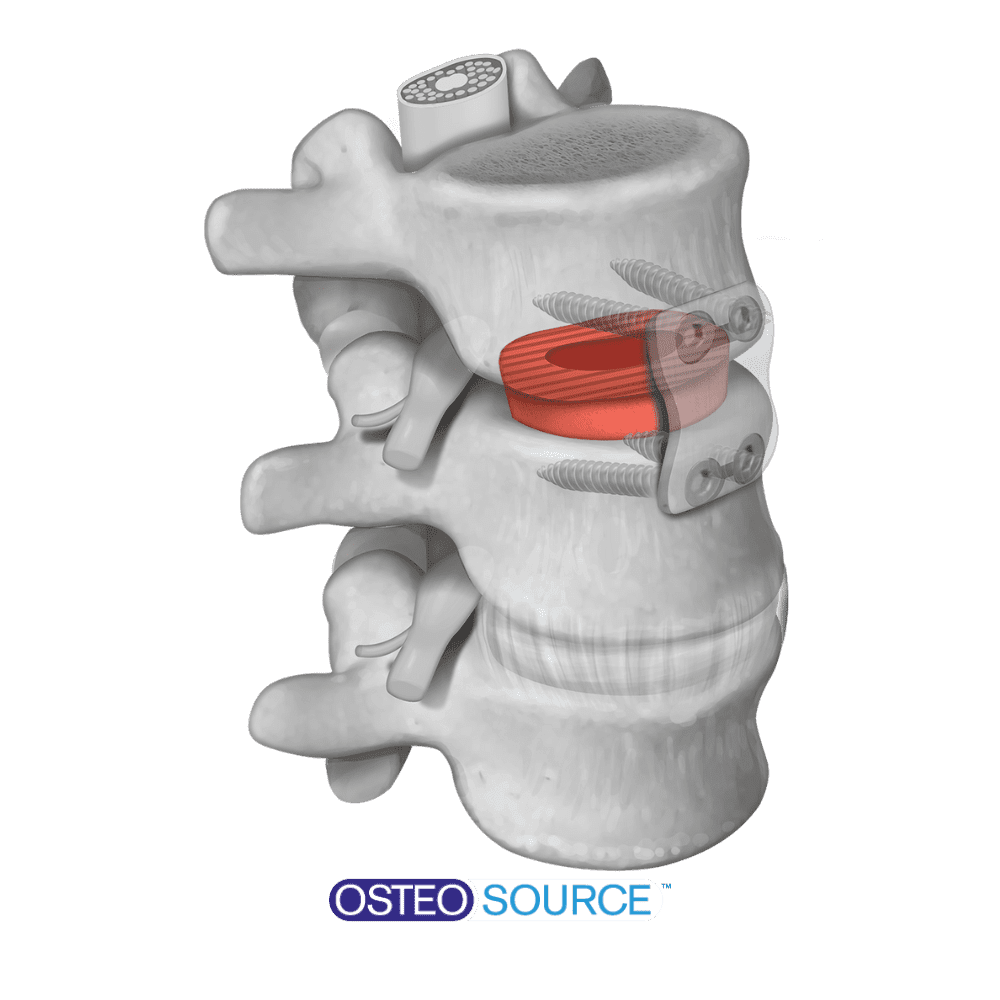 5 - Osteo-Source