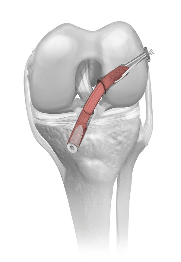 ACLR with BTB, cortical fixation in femur, and screw in tibia