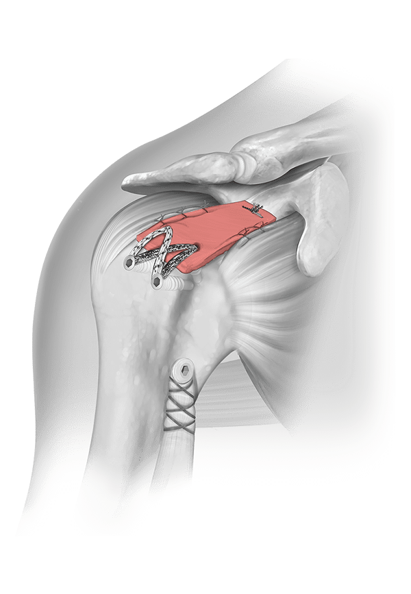 SCR with Coll-e-Derm and Dynatape