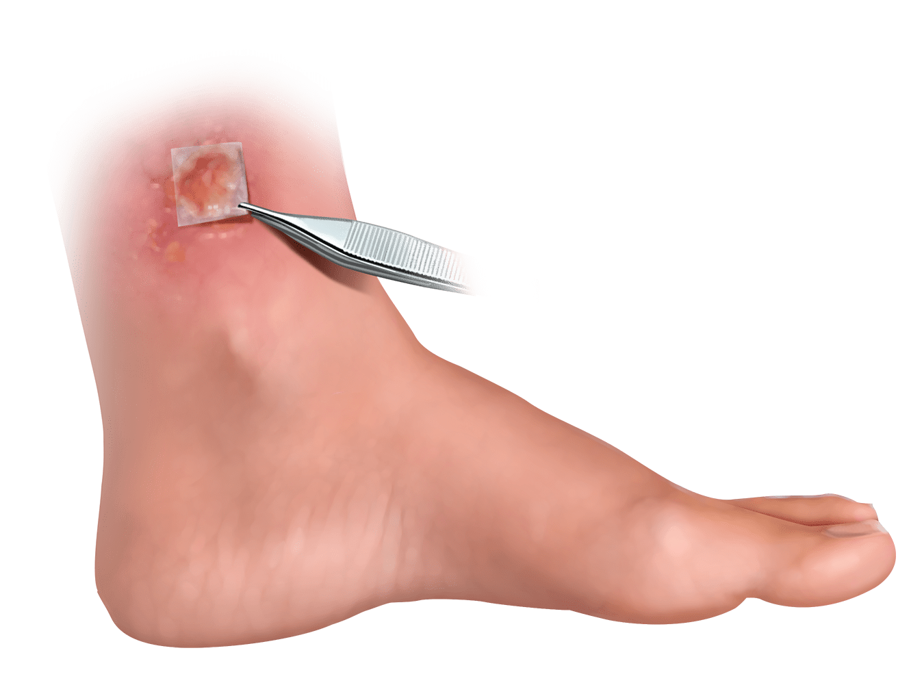 Venous Leg Ulcer with Restorigin™